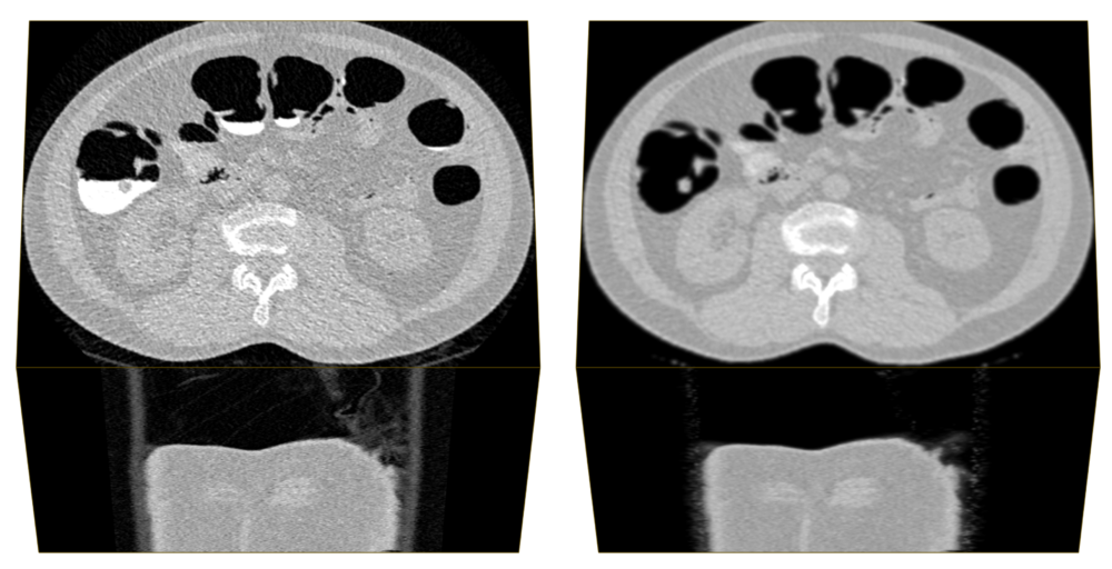CT画像。同じような画像が2枚。左側の画像には大腸の腸内に白い影がある